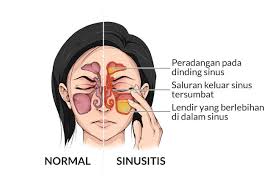 Operasi Sinus Endoskopi Fungsional: Metode Pengobatan Sinusitis