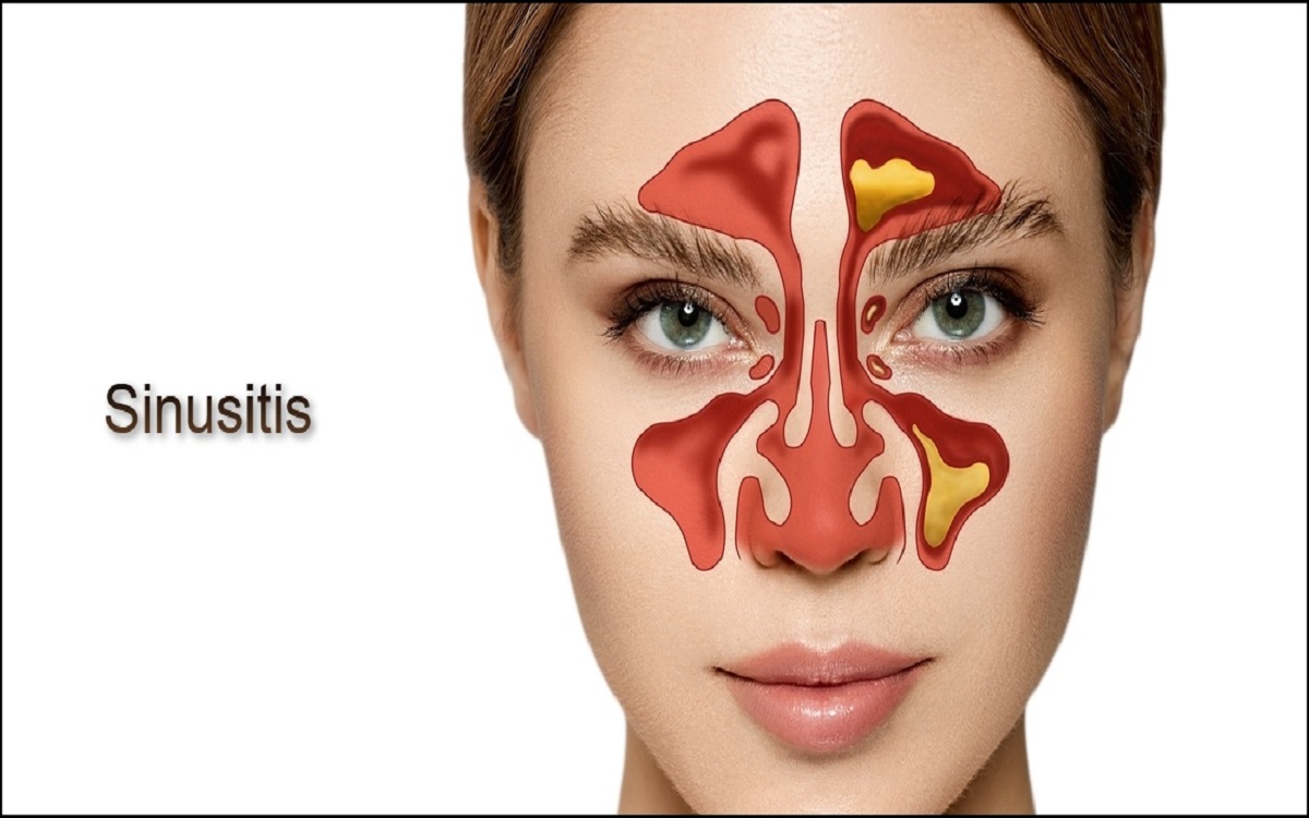 Ramai ramai Oplas Hidung Karena Sinus, Lalu Apakah Benar Sakit Sinus Harus Operasi ?