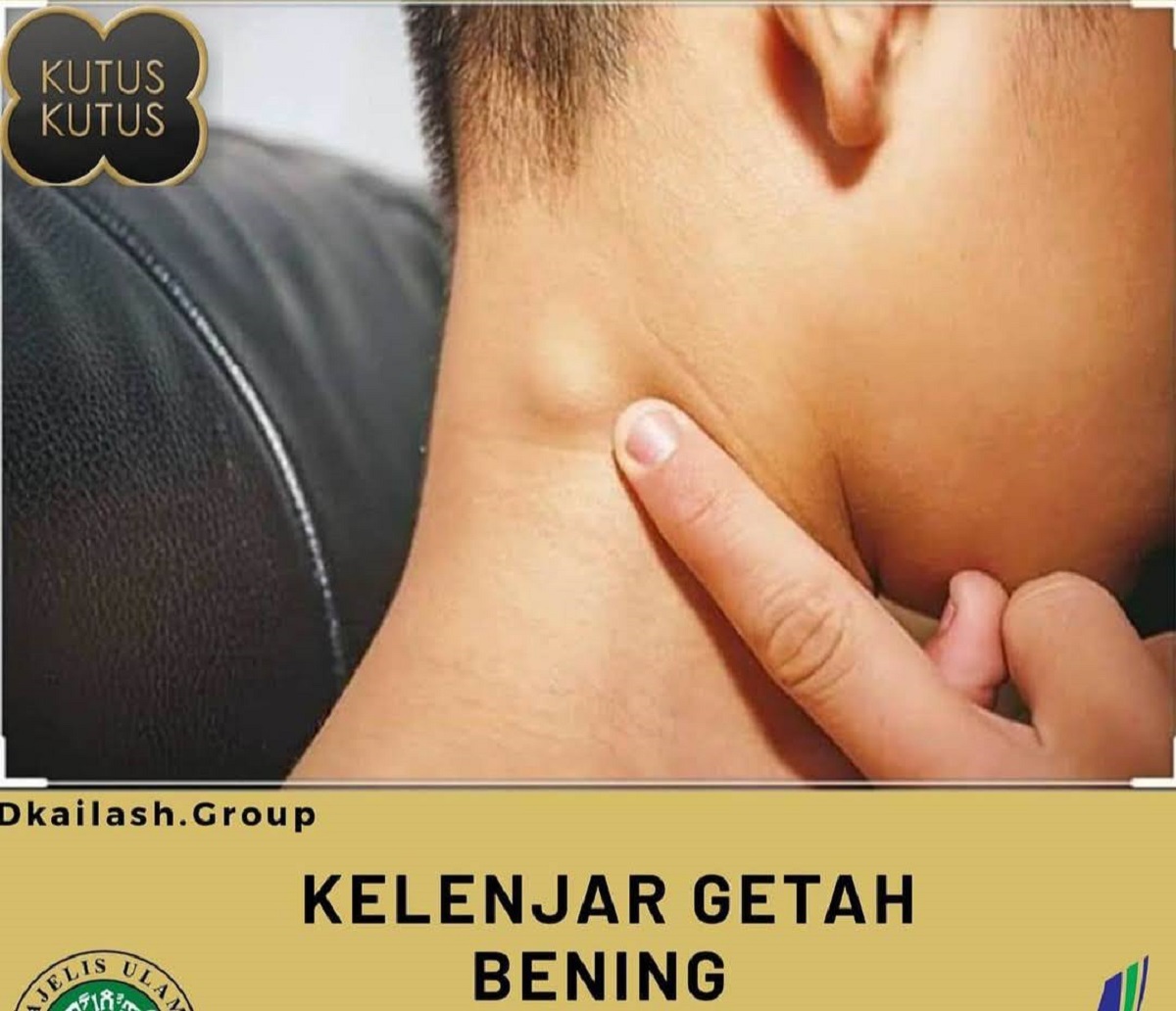 Tanpa Operasi, Kenali Penyebab dan Cara Mengobati Kelenjar Getah Bening