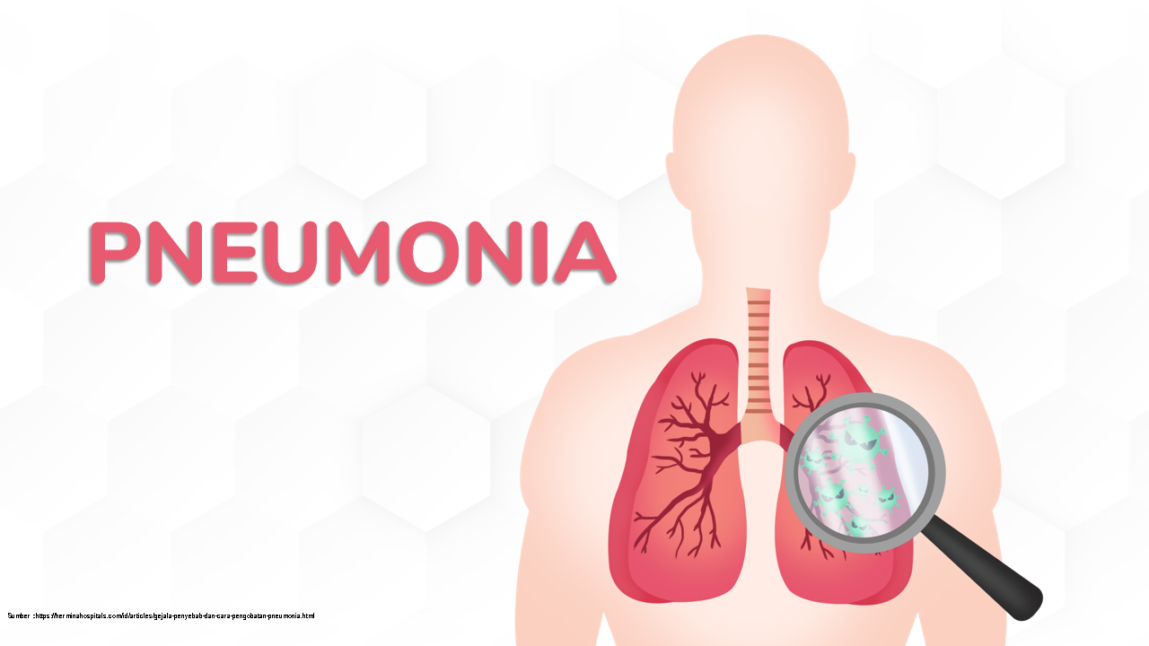  Ancaman Serius Pneumonia yang patut diwaspadai Pasca COVID-19