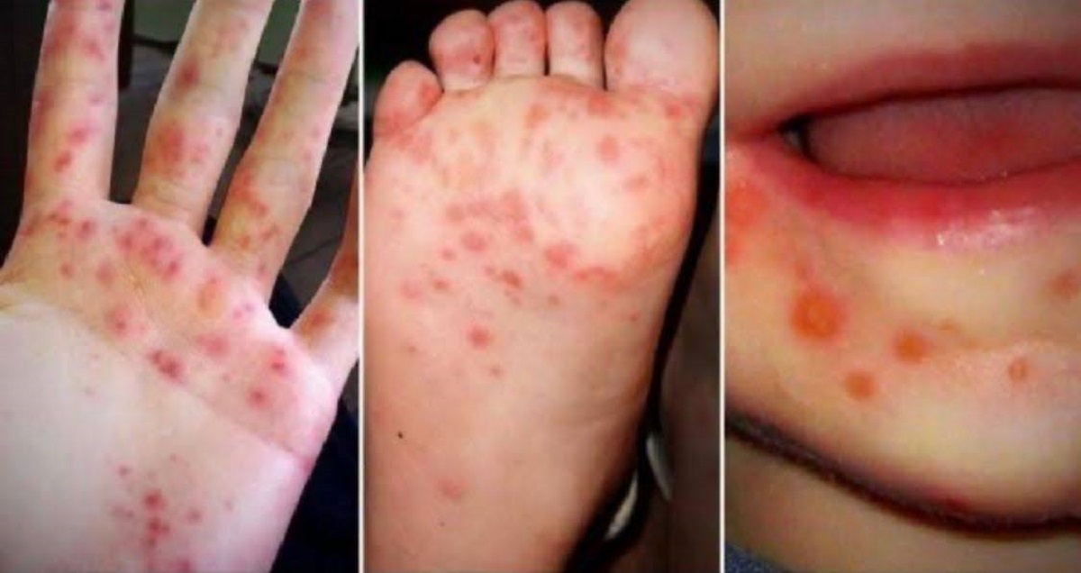 Sedang Meningkat, Waspadai Flu Singapura Pada Anak