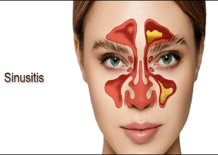 Ramai ramai Oplas Hidung Karena Sinus, Lalu Apakah Benar Sakit Sinus Harus Operasi ?