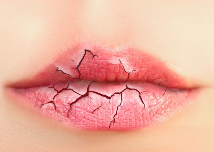 Perlu Tahu, Ternyata Ini Penyebab dan Cara Mengatasi Bibir Pecah-Pecah hingga Tuntas