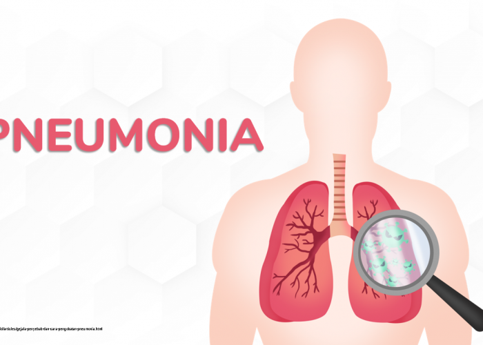  Ancaman Serius Pneumonia yang patut diwaspadai Pasca COVID-19